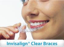 Invisalign Clear Braces